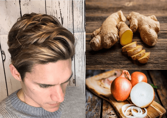 Cách trị gàu bằng gừng kết hợp với hành tây 