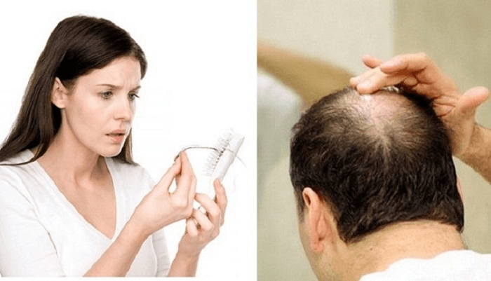 Rụng tóc đột ngột ở nam giới  Nguyên nhân và hướng điều trị