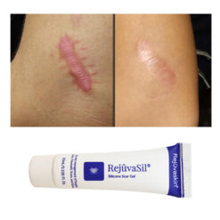 Sau khi sử dụng kem sẹo Rejuvasil Scar vết sẹo của bạn sẽ dần mờ đi