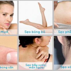 Những vết sẹo sẽ biến mất sau khi bạn sử dụng kem Sẹo Scar Esthetique